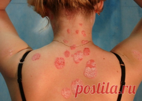 Поразительное открытие в лечении псориаза