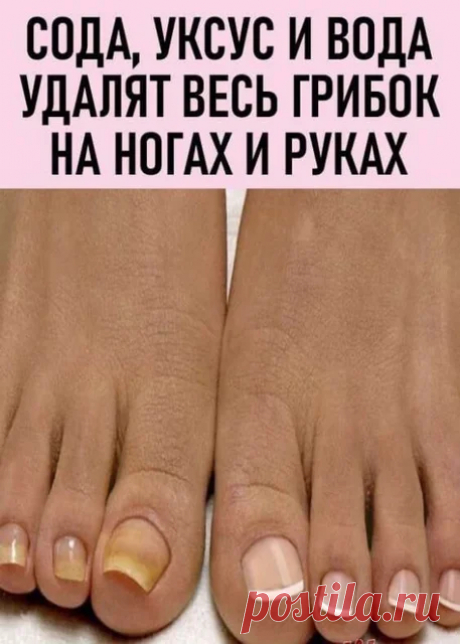 СОДА, УКСУС И ВОДА УДАЛЯТ ГРИБОК НА НОГАХ И РУКАХ..
