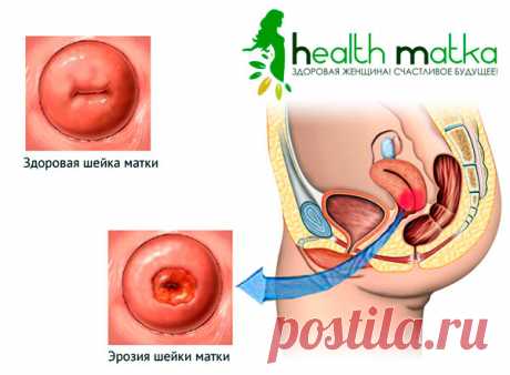 Лечение эрозии матки шейки: все возможные способы