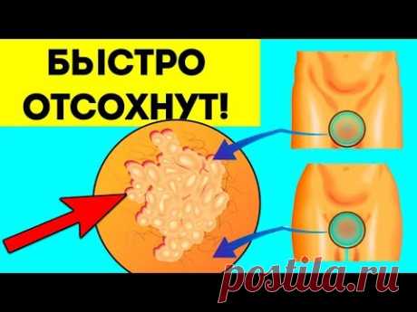 Папилломы отпадут быстро. Самый простой способ удаления висячих родинок в домашних условиях дёшево