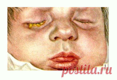 Ophthalmia neonatorum