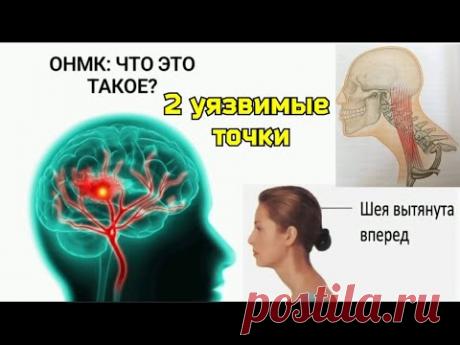 СПАЗМ позвоночной артерии - ПРИЧИНА инсульта мозга. Роль мышц ШЕИ: нижней косой, передней лестничной