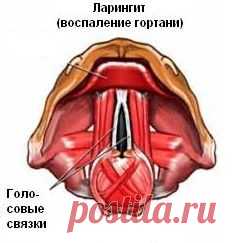 ЛАРИНГИТ - СИМПТОМЫ И ЛЕЧЕНИЕ
