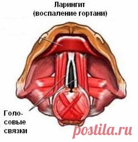 ЛАРИНГИТ - СИМПТОМЫ И ЛЕЧЕНИЕ