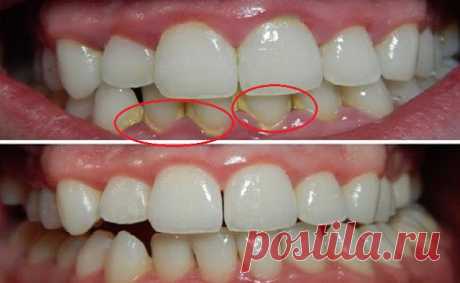 Как естественно удалить зубной налет за 5 минут, не обращаясь к стоматологу   Натуральное средство Налет — это накопление пищевых отходов на внутренней и внешней поверхностях зубов. Это оральное заболевание может вызывать