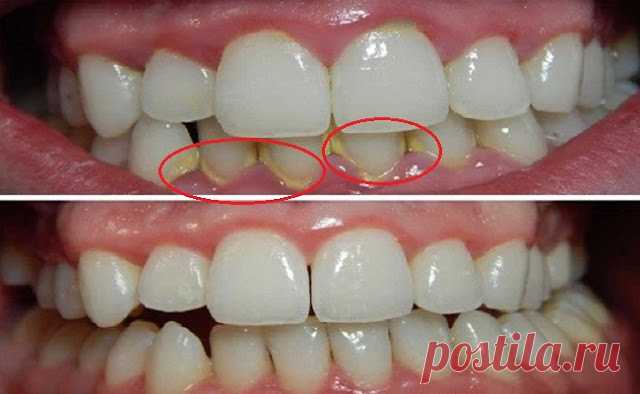 Как естественно удалить зубной налет за 5 минут, не обращаясь к стоматологу   Натуральное средство Налет — это накопление пищевых отходов на внутренней и внешней поверхностях зубов. Это оральное заболевание может вызывать