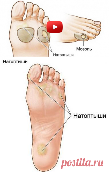 Моментально избавится от натоптышей и мозолей!