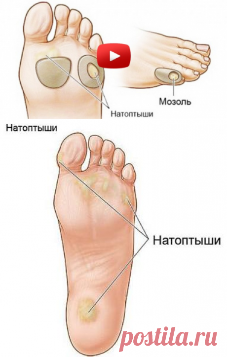 Моментально избавится от натоптышей и мозолей!