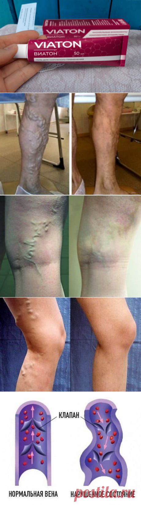 варикозное расширение вен у женщин – опасная патология. Однако сегодня она просто лечится в домашних условиях
Meduza 24 декабря 2021
По статистике, варикозное расширение вен и нарушение кровотока диагностируются у 72% женщин старше 50 лет (37% у женщин старше 30 лет). Самое опасное в этой патологии то, что со временем лучше не будет – расширение подкожных вен будет только усиливаться, а значит отечность конечностей, болевые ощущения и риск тромбоза сосудов будут 
упаковка подарков