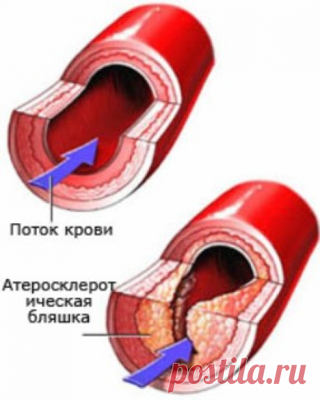 Для профилактики атеросклероза