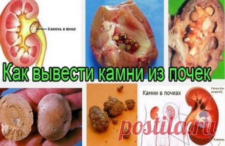 СРЕДСТВО ОТ КАМНЕЙ В ПОЧКАХ И В ЖЕЛЧНОМ ПУЗЫРЕ
	
1 ч. ложку семян моркови залить 1 стаканом воды, довести до кипения и варить на малом огне 10 минут. Настаивать 30-40 минут, процедить. Пить теплым по 1/2 стакана 3-4 раза в день. Курс лечения – месяц. 
После недельного перерыва повторить.
Знахарское средство от камней в печени и почках
	
Пропустить через мясорубку один стакан конопляного семени, смешать с тремя стаканами сырого молока и уварить до одного стакана. Горячим пр...