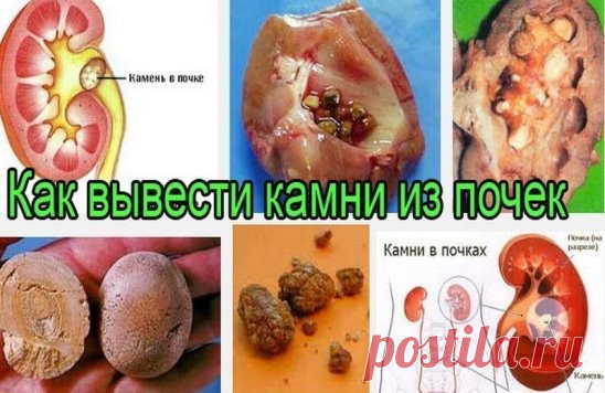 СРЕДСТВО ОТ КАМНЕЙ В ПОЧКАХ И В ЖЕЛЧНОМ ПУЗЫРЕ
	
1 ч. ложку семян моркови залить 1 стаканом воды, довести до кипения и варить на малом огне 10 минут. Настаивать 30-40 минут, процедить. Пить теплым по 1/2 стакана 3-4 раза в день. Курс лечения – месяц. 
После недельного перерыва повторить.
Знахарское средство от камней в печени и почках
	
Пропустить через мясорубку один стакан конопляного семени, смешать с тремя стаканами сырого молока и уварить до одного стакана. Горячим пр...