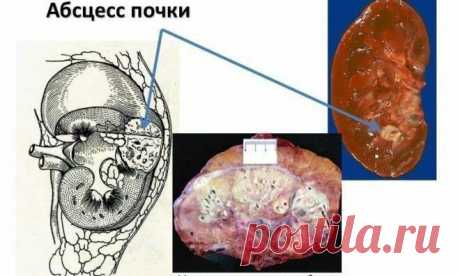 «При каких заболеваниях необходима расшифровка УЗИ почек? Расшифровка УЗИ почек в норме и при некоторых патологических состояниях. Возможности и доступность данного вида исследования. Основные термины, которые встречаются при прочтении результатов ультразвуковой диагностики. Соотношение толщины, ширины и длины органа у взрослого человека считается нормальным, если эти параметры составляют: 40−50 мм на 50−60 мм на 100−120 мм. Толщина почечной парен...