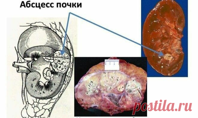 «При каких заболеваниях необходима расшифровка УЗИ почек? Расшифровка УЗИ почек в норме и при некоторых патологических состояниях. Возможности и доступность данного вида исследования. Основные термины, которые встречаются при прочтении результатов ультразвуковой диагностики. Соотношение толщины, ширины и длины органа у взрослого человека считается нормальным, если эти параметры составляют: 40−50 мм на 50−60 мм на 100−120 мм. Толщина почечной парен...