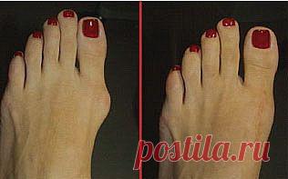 Подагра и гиперурикемия
(аллопуринол)