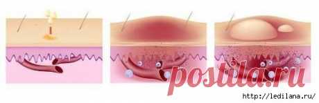 Как лечить крапивницу народными средствами