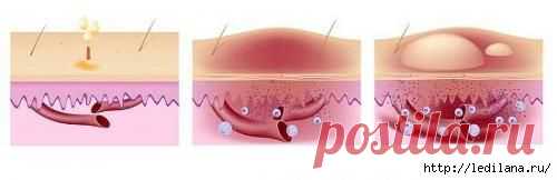 Как лечить крапивницу народными средствами