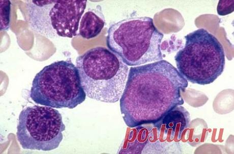 Мегалобластная анемия: симптомы, лечение, что это такое