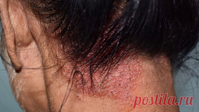 В Свердловской области пятеро детей заразились стригущим лишаем в стенах школы. В Первоуральске Свердловской области у пятерых школьников выявили микроспорию (стригущий лишай). Сообщение об этом было опубликовано в Telegram-канале регионального Минздрава. В ведомстве подготовили официальный ответ после появления ...