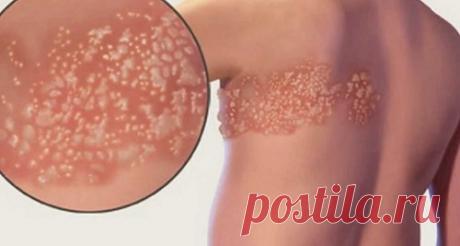 Опоясывающий лишай симптомы и лечение у взрослых