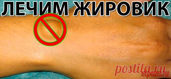 ЛЕЧИМ ЖИРОВИК | Это Полезно Знать Наверняка многие из вас знают, что такое жировик. Это безболезненная шишка на теле, которая кроме неэстетичного вида никаких неудобств не приносит. Она просто есть и многие с ней смиряются и живут с ней годами....