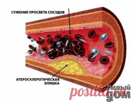 Избавляемся от холестерина народными средствами