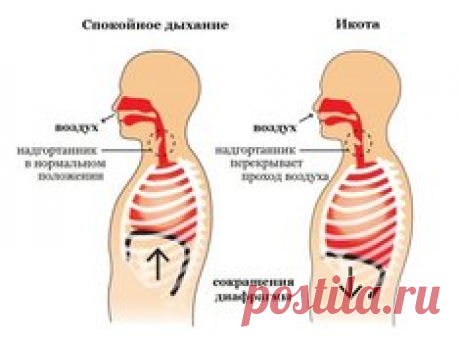 Как избавиться от икоты легко и быстро