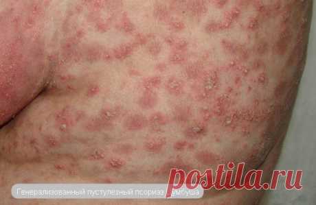 Пустулезный псориаз (фото), как лечат такое заболевание