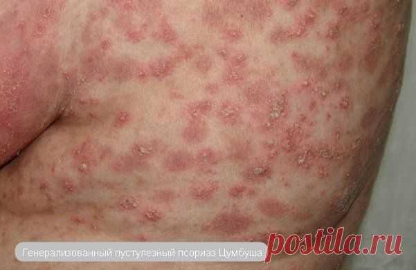 Пустулезный псориаз (фото), как лечат такое заболевание