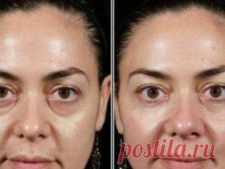 Как в домашних условиях убрать отёк под глазами?: FunNETWORK