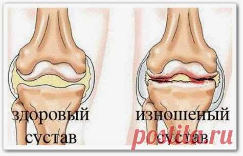 Артроз коленных суставов (видео урок)