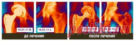 Специализированный центр по лечению асептического некроза