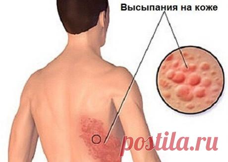 Лечение опоясывающего лишая натуральными средствами Вирус попадает в организм и «засыпает», и однажды сложившиеся определенным образом условия вынуждают его выйти на поверхность.