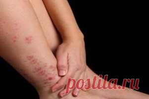 Лечение варикоза хозяйственным мылом - отзывы людей