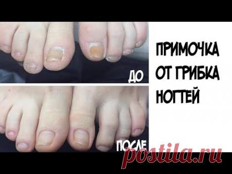 ШОК!!!Именно это средство поможет навсегда избавиться от грибка ногтей