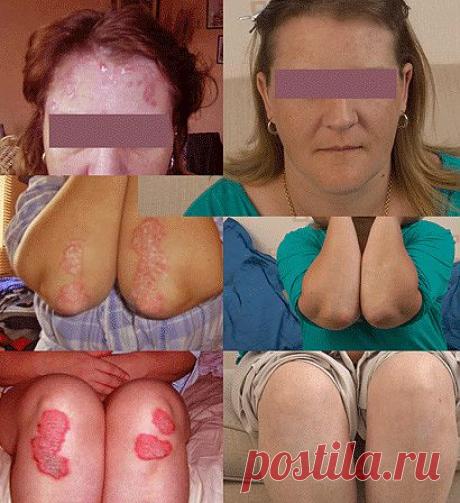 Как я вылечила псориаз