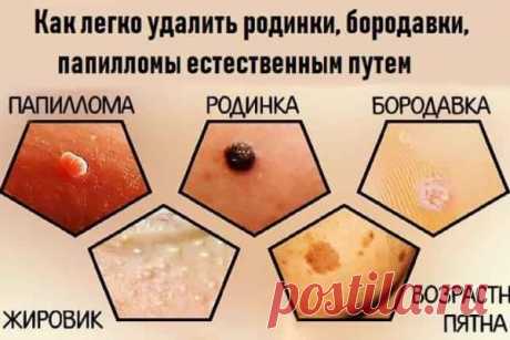 как избавиться от папиллом средства в аптеке	Можно купить средства для удаления папиллом в аптеке, а также найти их среди домашних медикаментов или даже кухонных приправ.При помощи народных средств мгновенно избавиться от папиллом не получится. Но регулярное применение некоторых масел ускорит...