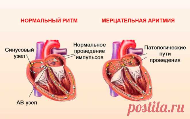 Аритмия — болезнь сердца, а лечить нужно нервы - Все обо Всем   Признаки аритмии — перебои, замирание сердца, резкое хаотическое сердцебиение. Многие виды аритмии не представляют угрозы для человека, но обязательно обратите внимание на состояние нервной системы. Появлению сердцебиения способствует большая физическая нагрузка, волнения, высокая температура воздуха, воздействие табака, алкоголя, кофе, чая; может возникнуть при заболевании сердечно-сосудистой системы, невроза...
