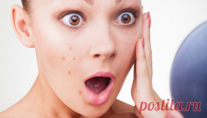 Как НАВСЕГДА избавиться от прыщей? Расскажу своей дочке!