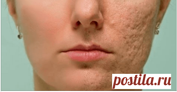 Протрите этим любой шрам, морщину или пятно на коже и посмотрите, как они исчезнут через несколько минут! | Женские заметки