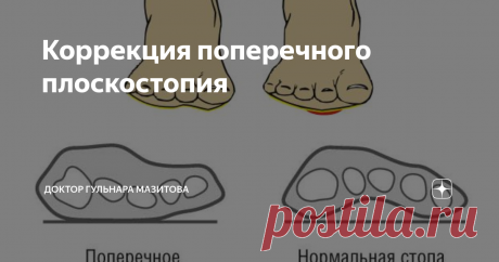 Коррекция поперечного плоскостопия Дарю простое, но эффективное упражнение для лечения поперечного плоскостопия. ⠀
Как его обнаружить?⠀
