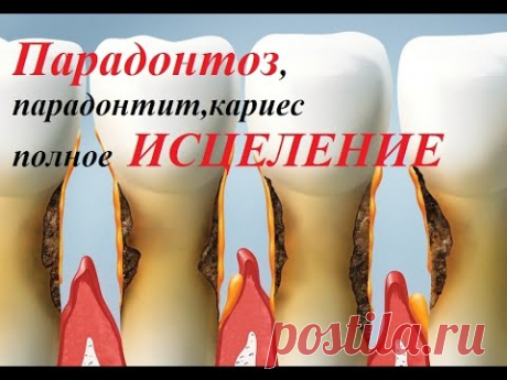 ПАРОДОНТОЗ-УНИКАЛЬНЫЙ МЕТОД ИСЦЕЛЕНИЯ
