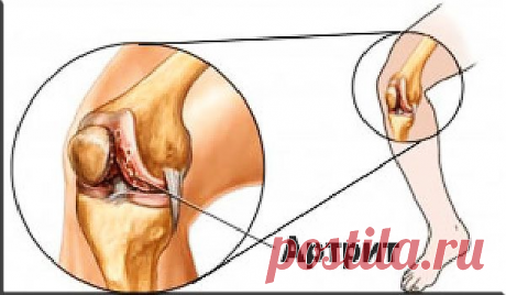 Как победить артрит?