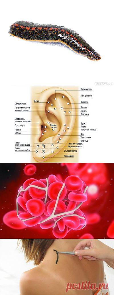 Гирудотерапия, лечения с помощью пиявок. Часть 1 | Самые популярные и самые вкусные рецепты с видео