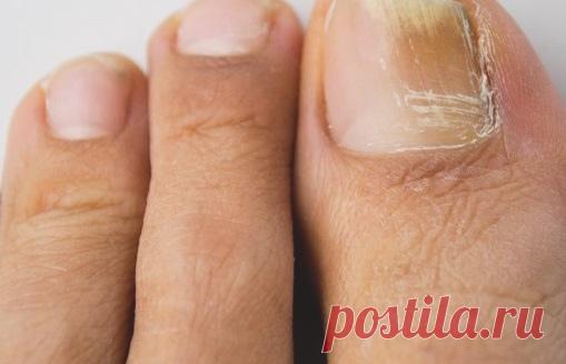 5 лучших народных средств для лечения грибка ногтей.