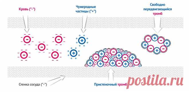 Электронная методика "Персональный флеболог" (варикоз)