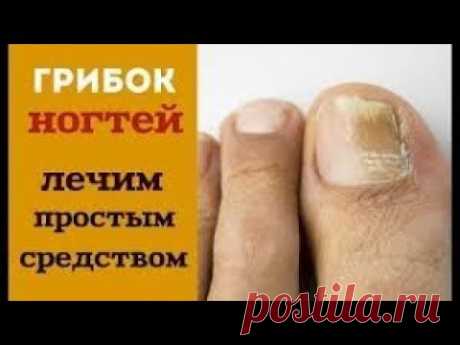 ГРИБОК НОГТЕЙ - как ветром сдует ЗА 15 МИНУТ. Лечение грибка ногтей