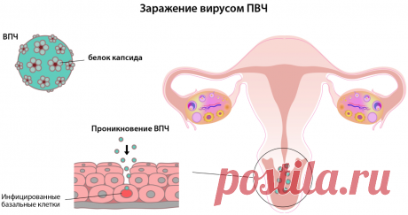 Лечение ВПЧ: есть ли работающие подходы к терапии?