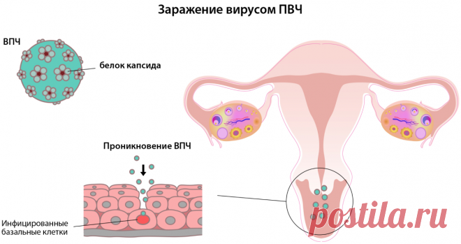 Лечение ВПЧ: есть ли работающие подходы к терапии?
