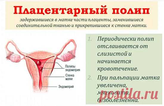 Плацентарный полип: что это и как с ним поступить?